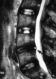 La flecha indica una zona blanca al borde de una disco, esta es la fisura y muestra una zona de inflamación, que puede generar dolor lumbar agudo o referido.